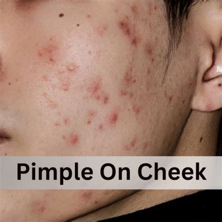 When does pimples occur?