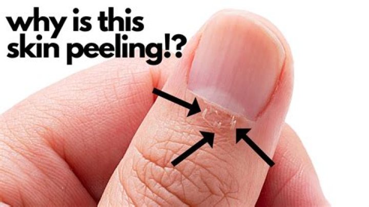 Where did peeling come from?