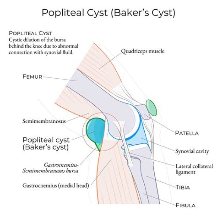 Where is a baker's cyst located in the knee?