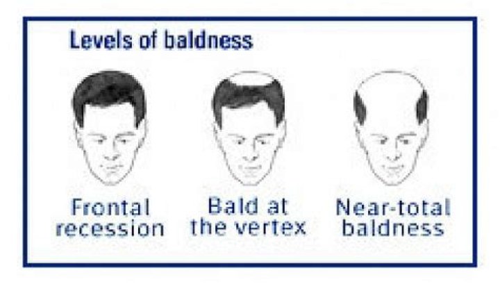 Where is baldness inherited from?