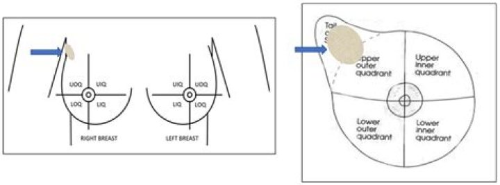 Where is retroareolar region of the breast?