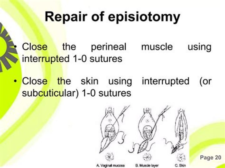 Which is worse episiotomy or tear?