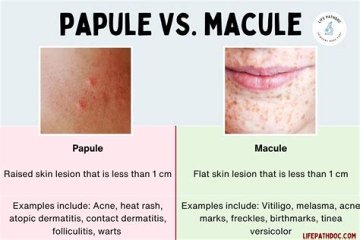 Which of the following is an example of macules?