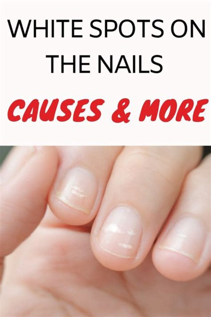 Why are my nails spotted white?