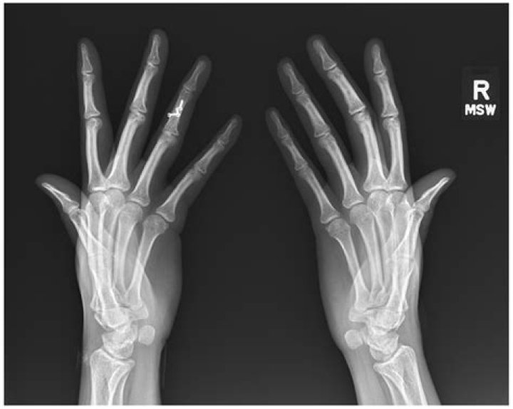 Will a bone spur show up on an x ray?