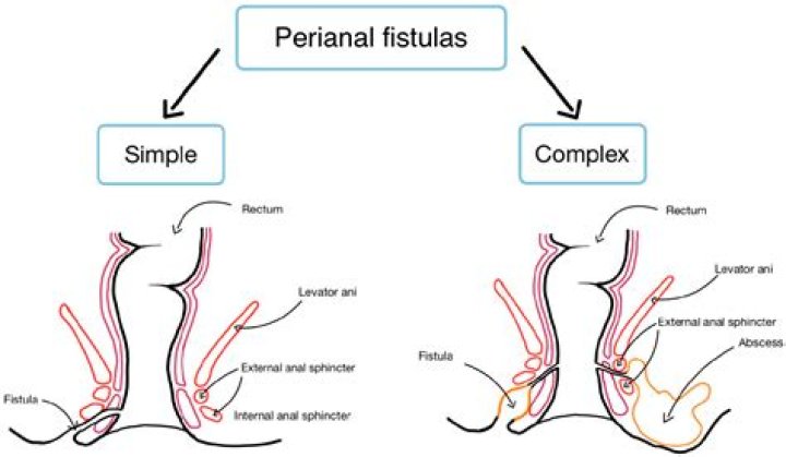 Will fistula heal themselves?