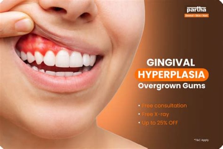 Will gingival hyperplasia go away?