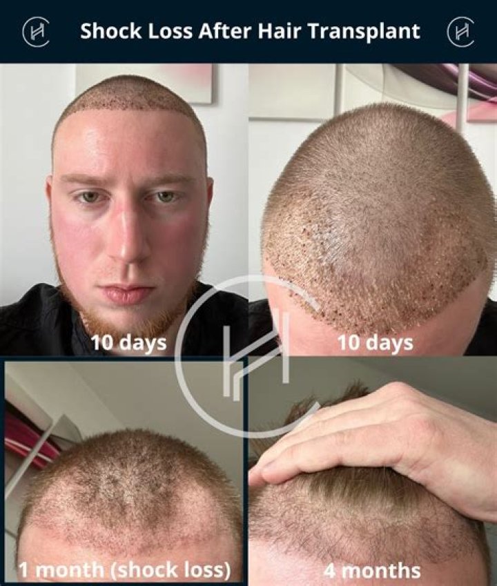 Will hair loss grow back?