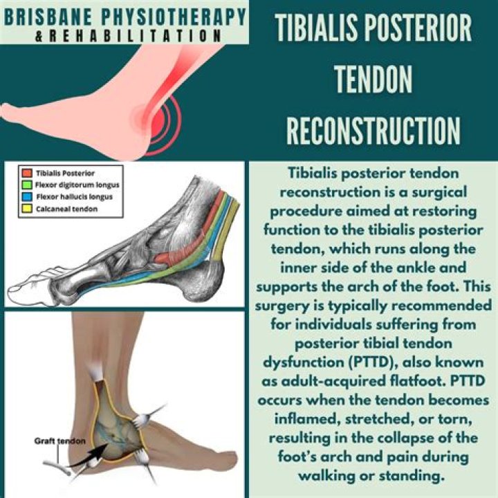 Will posterior tibial tendonitis go away?