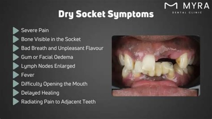 Will smoking cause dry socket?