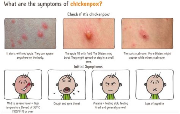 Will steroids help chickenpox?