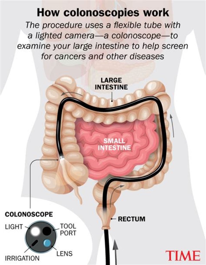 Would a colonoscopy show a fistula?
