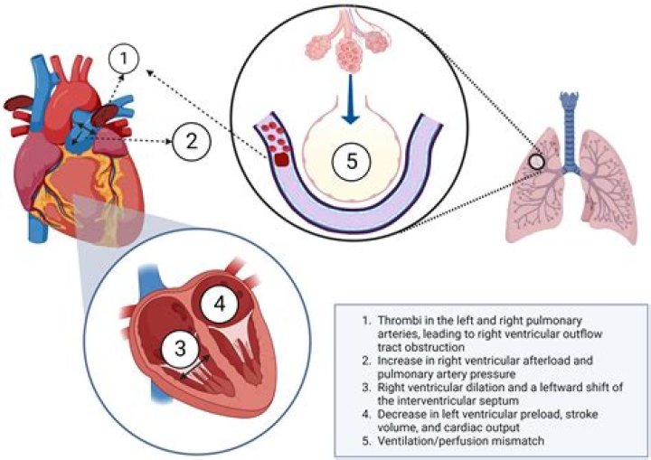 Would i know if i had a pulmonary embolism?
